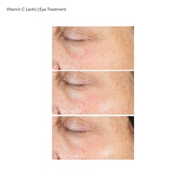 Vitamin C Lactic - Soin Contour des Yeux Eclat