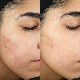 Contrôle des Imperfections - Soin resurfaçant InvisiScar