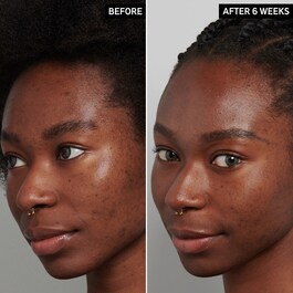 Soin de nuit contre l'hyperpigmentation à l'acide tranexamique