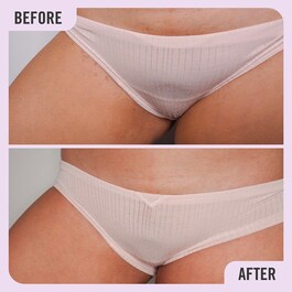 Ingrown Hair Pads - Disques Pour Poils Incarnés aux BHA & AHA 