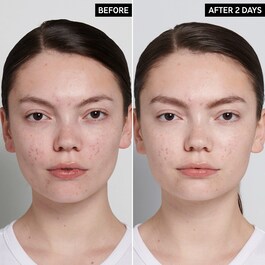 Soin anti-imperfections à l'acide succinique