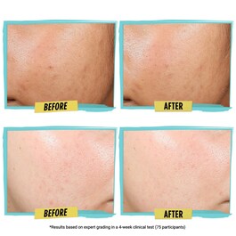 Expertly Clear Blemish-Treating & Preventing Lotion - Lotion Anti-Imperfections