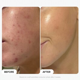 Multi-Level Exfoliation Trial Kit - Duo Découverte Exfoliants AHA + BHA