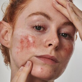 Solution Anti-rougeurs avec de l'acide azélaïque 10 % - Sérum visage