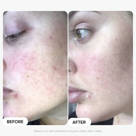 The Breakout Fighting Kit - Coffret de Soins Essentiels Imperfections