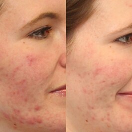 Contrôle des Imperfections - Soin clarifiant anti-imperfections Outsmart