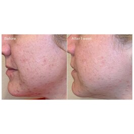 Blemish Control - Peeling Clarifiant Quotidien 