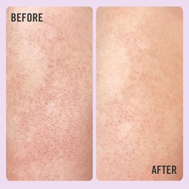KP Bump Eraser Body Scrub with 10% AHA - Exfoliant Corporel aux AHA