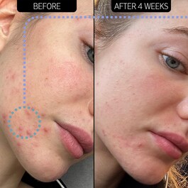Blemish Clearing Moisturizer 2% NovoRetin - Crème de Nuit Hydratante