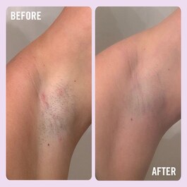 Ingrown Hair Pads - Disques Pour Poils Incarnés aux BHA & AHA 