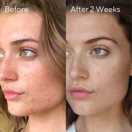 Contrôle des Imperfections - Soin resurfaçant InvisiScar