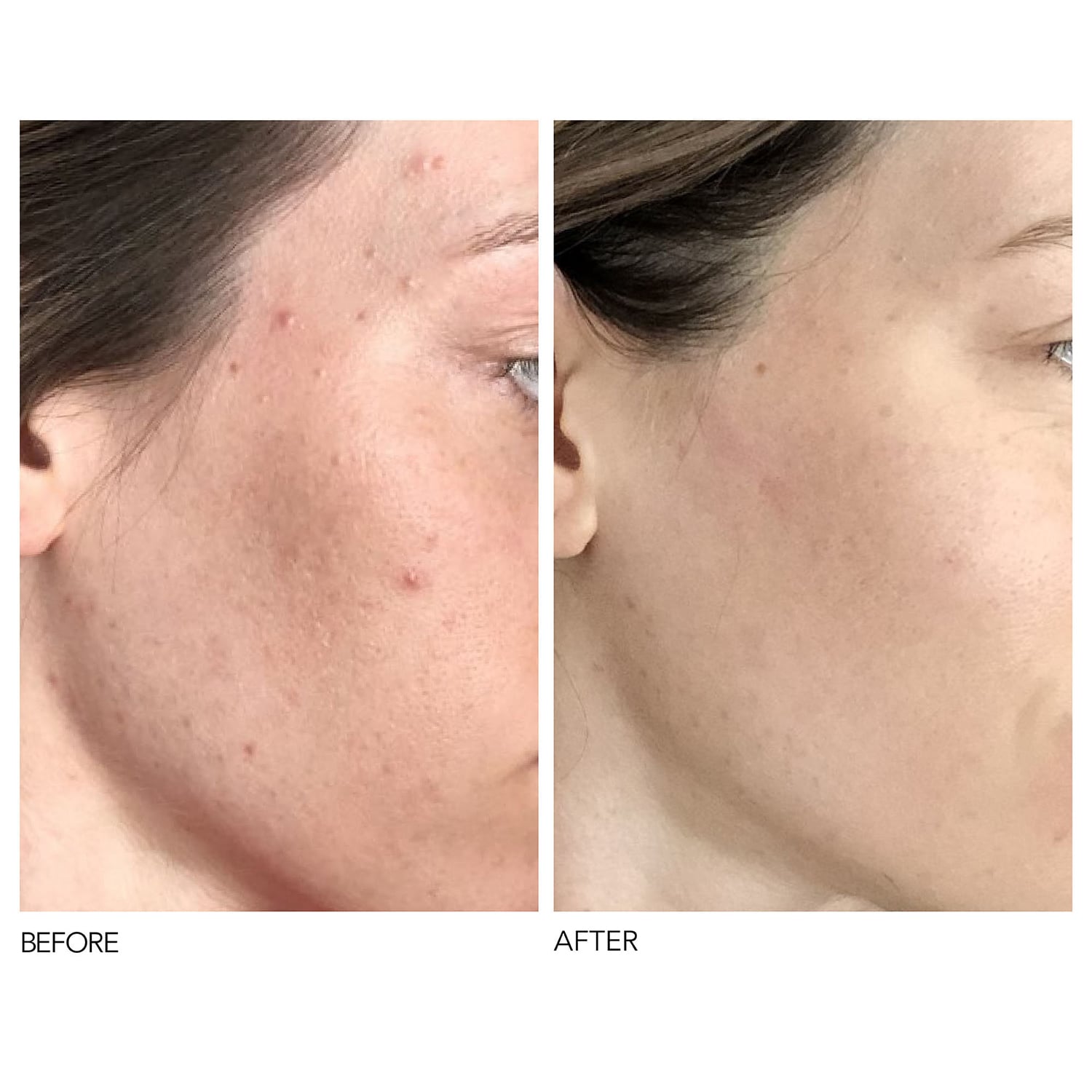 Alpha Beta® Peeling Quotidien Formule Universelle de DR DENNIS GROSS