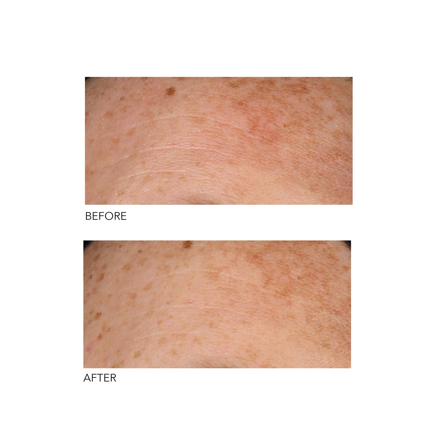 Alpha Beta® Peeling Quotidien Formule Universelle de DR DENNIS GROSS